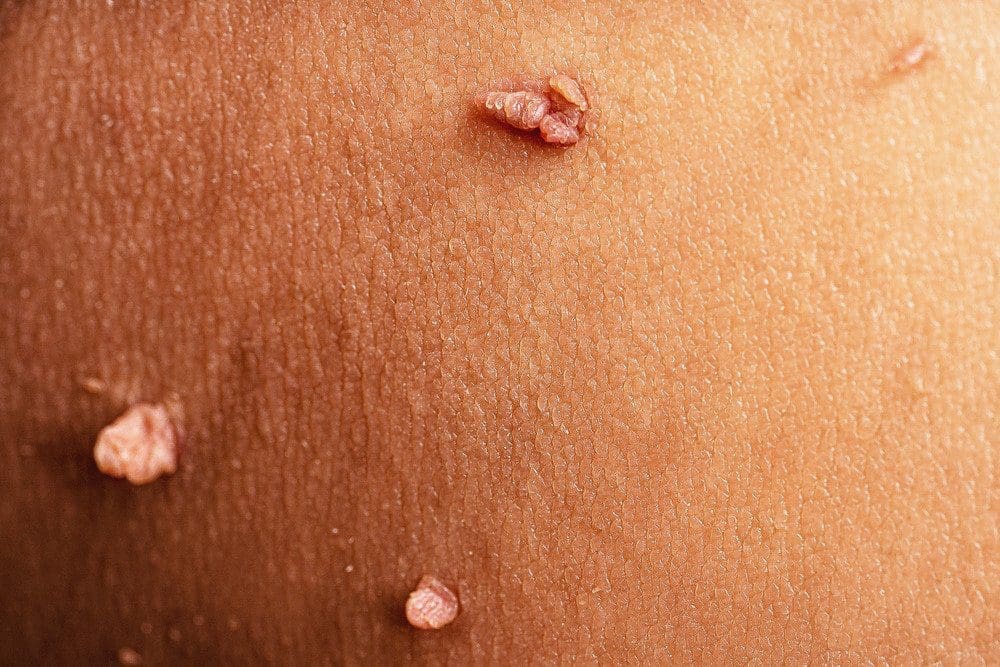Genital Warts: Transmission, Causes, Signs And Symptoms, Treatment, Complications and Prevention